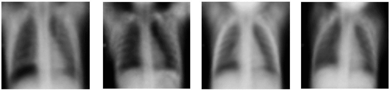 Generating Medical Images using Variational Autoencoder